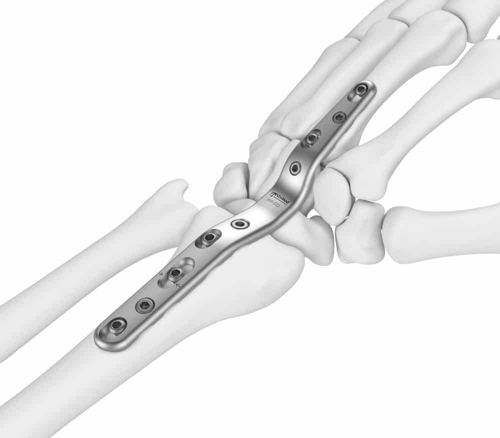 Total Wrist Fusion Plate - Wrist Fracture Fixation - TriMed Inc.